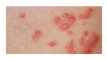 Dermatololgical emergencies, Vitiligo treatments and Infestations