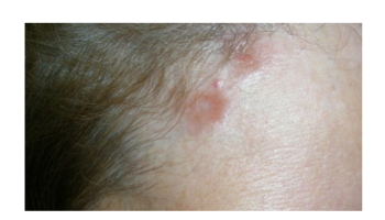 Treatment of dermatomyositis and sarcoidosis