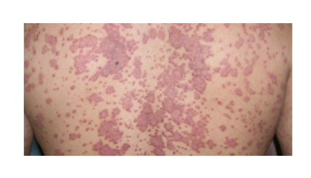 Systemic treatment options for psoriasis and Systemic treatment of Lichen Planus