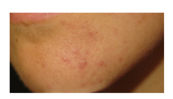 Atopic dermatitis and Acne 2