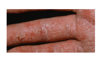 Patch testing and contact dermatitis and Cuteaneous lymphomas