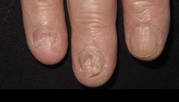 Rare nail disorders and Cicatricial alopecia