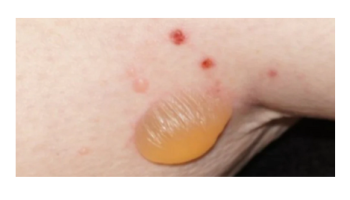 Hidradenitis suppurativa and Bullous pemphigoid