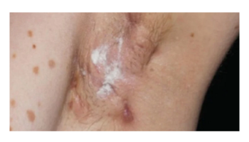 Challenging general dermatology cases