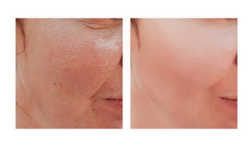 Laser use: Pigment melasma and resurfacing