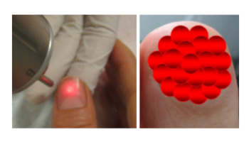 Non-aesthetic use of lasers