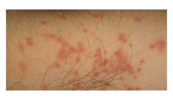 Bites: Animals, snakes and insects