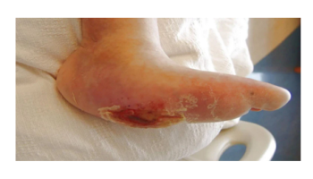 Skin ulcers, pressure sores and wound care