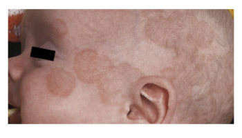 Pregnancy Dermatoses