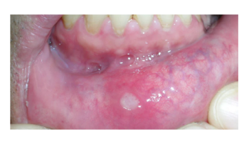 Oral mucosal diseases