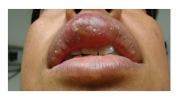 Urticaria and Drug eruptions