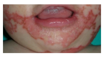 Nutritional dermatoses and Delusions of parasitosis