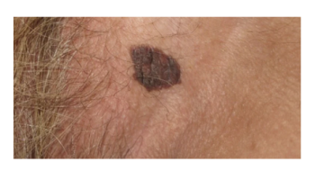 Vulvar skin diseases