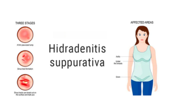 Hidradenitis suppurativa diagnosis and treatment