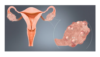 Polycystic Ovarian Syndrome