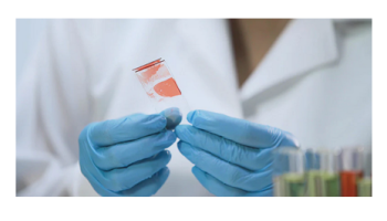 Hepatitis A, B and C