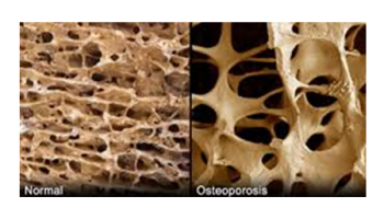 Osteoporosis