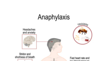 Anaphylaxis – causes, symptoms, emergency treatment