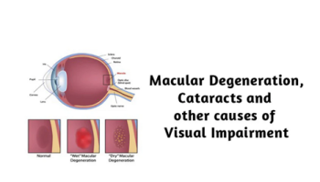 Macular Degeneration , Cataracts and other causes of visual impairment