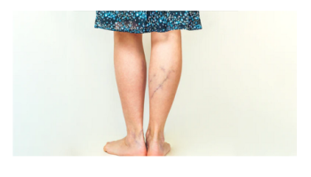 Varicose veins, venous leg ulcers and DVT