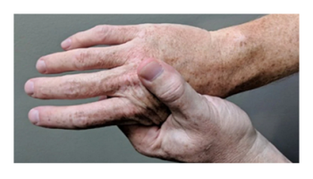 Inflammatory arthritis