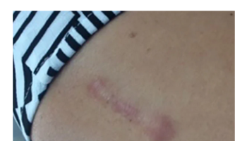 Principles of Wound Healing and Managing Small Procedures in General Practice