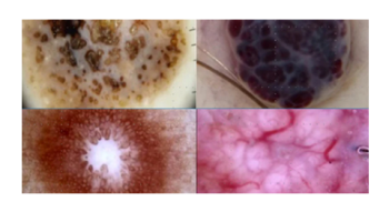 Non-melanocytic lesions Part 1
