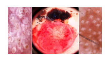 Virtual slides Dysplastic nevus: Fact and fiction