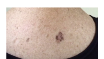 Histopathology of melanocytic lesions Part 1