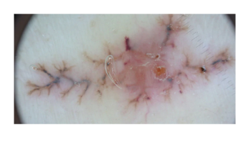 Common inflammatory dermatoses of the face and trunk