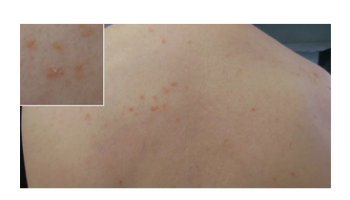 Disorders of pigmentation, infiltrative dermatoses and uncommon skin diseases
