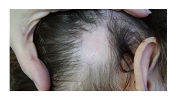 Trichoscopy of common alopecias
