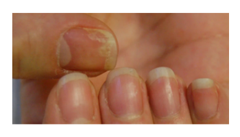 Dermatoscopy of inflammatory and infectious diseases of the nails