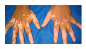 Dermatoscopy in skin of colour