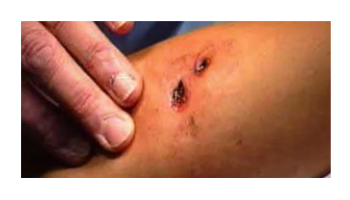 Lacerations and Wounds