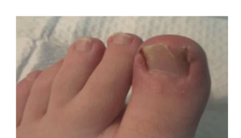 Ingrown Toenails
