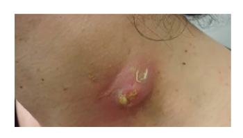 Lumps and Bumps