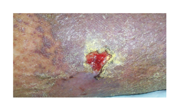 Managing Infected Lesions