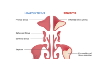 Sinusitis