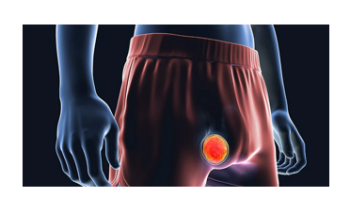 Testicular Cancer and Male Breast Cancer