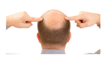 Male hair loss and genital inflammatory dermatoses