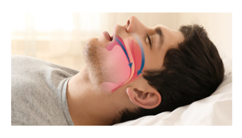 Obstructive sleep apnoea in men