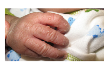Paediatric topics; Follicular disorders; Blistering disorders