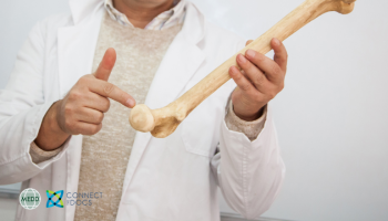 Estrogen Exit What Every GP Should Know About Postmenopausal Bone Risk