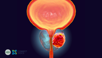 Prostate Cancer: Focal Therapy