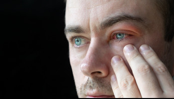 Neisseria meningitidis: an uncommon cause of conjunctivitis