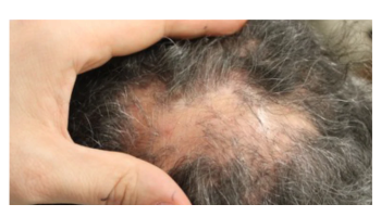 Examination and history taking for hair disorders