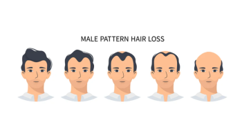Male pattern hair loss - diagnosis and treatment