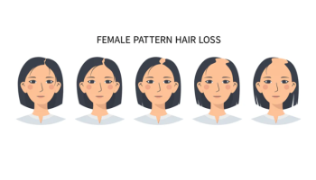 Female pattern hair loss - diagnosis and treatment
