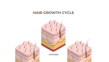 Telogen Effluvium